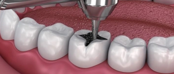 Damaged tooth evaluated for replacement